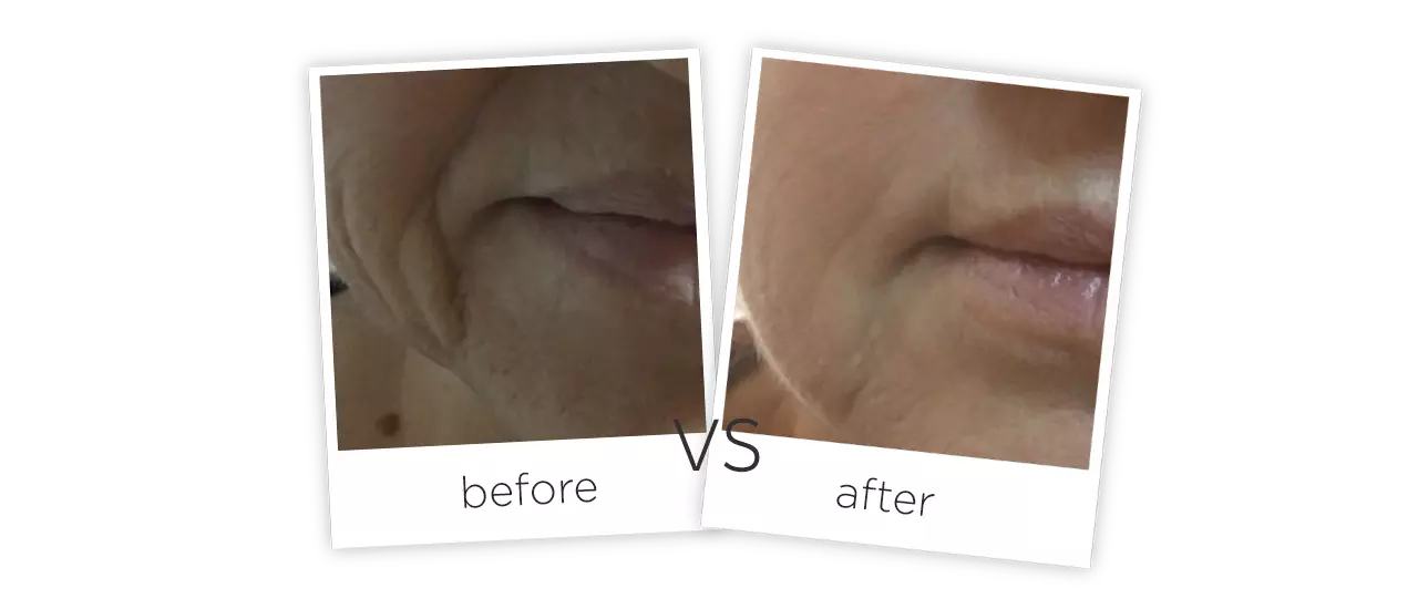 Wrinkle Removal Skin Tighten ADSS Laser