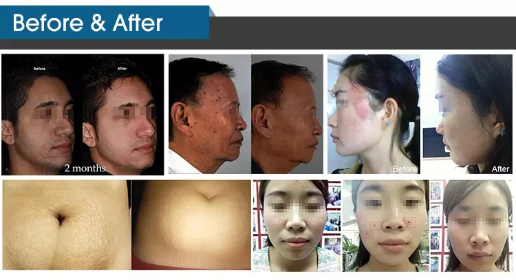 Co2 Laser Therapy Machine Co2 Laser Therapy Machine